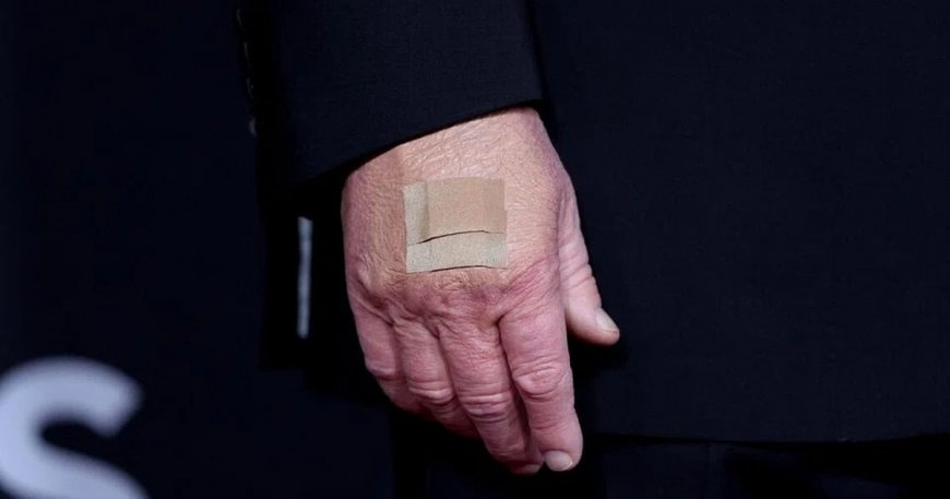 Nhà Trắng lý giải miếng băng dán trên tay Tổng thống Trump